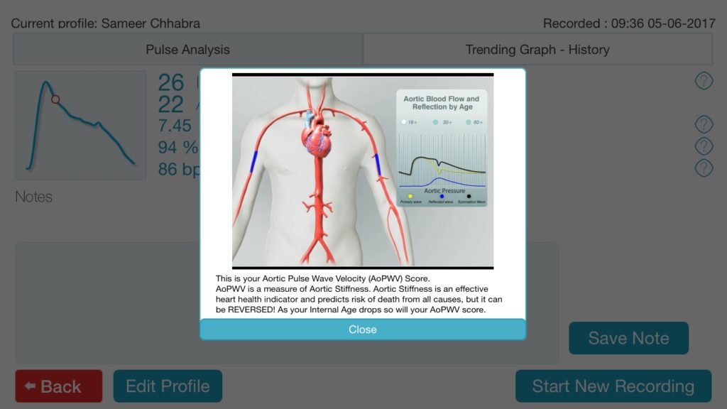 An image showcasing the iHeart app explaining aortic pulse wave velocity
